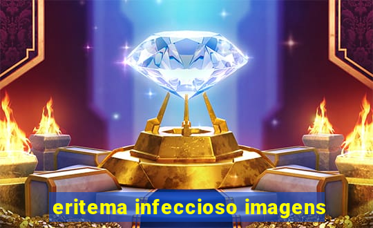 eritema infeccioso imagens